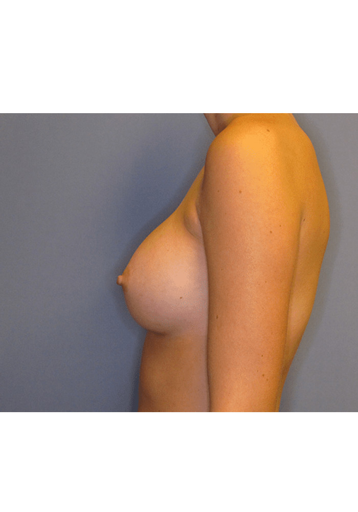 Breast Augmentation – Case 6