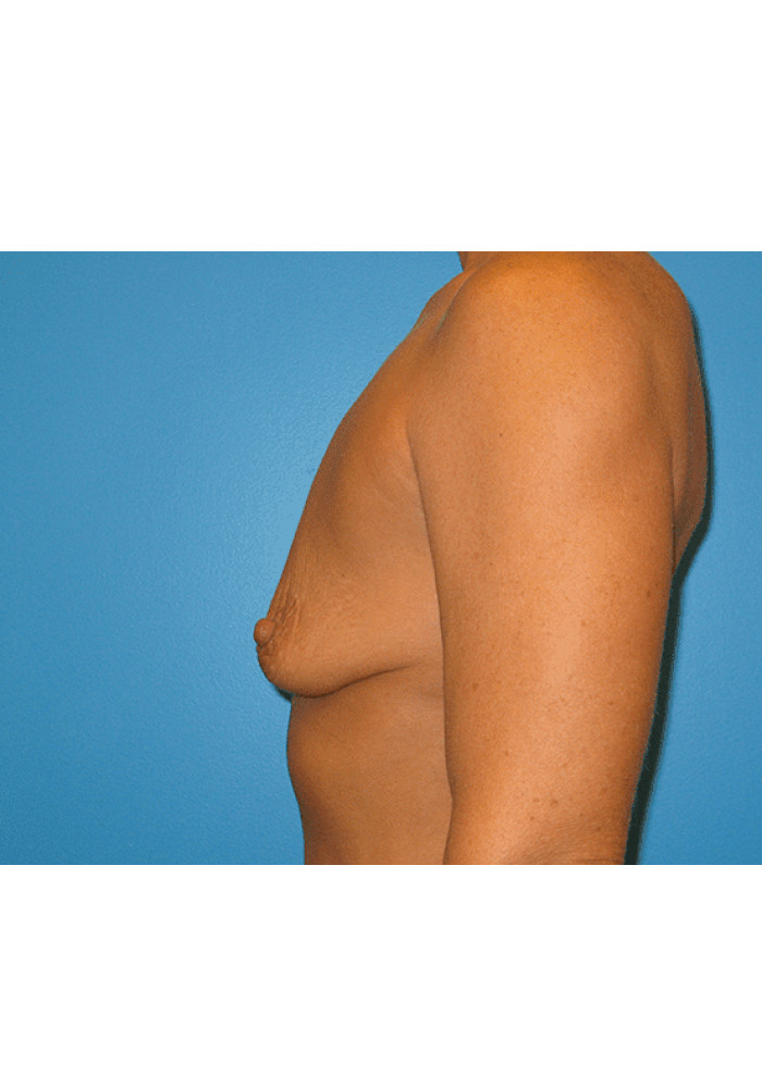 Breast Augmentation – Case 17