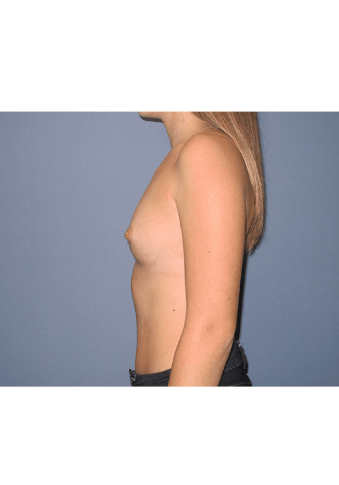 Breast Augmentation – Case 18
