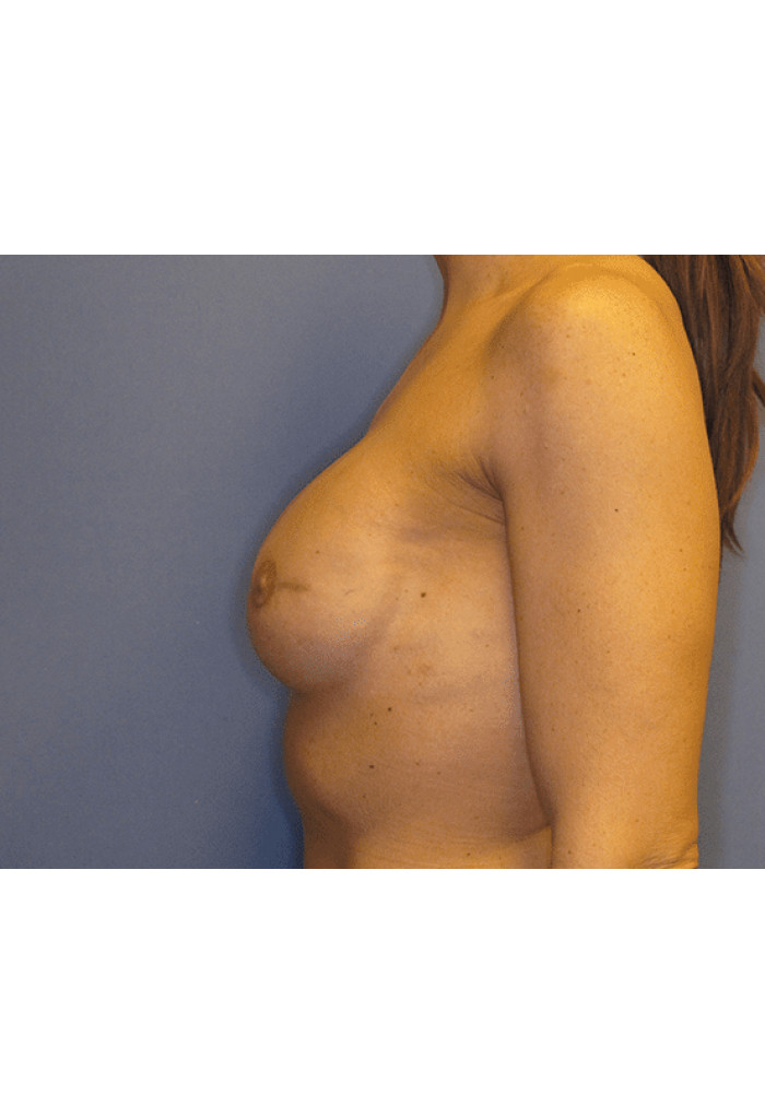 Breast Reconstruction – Case 1
