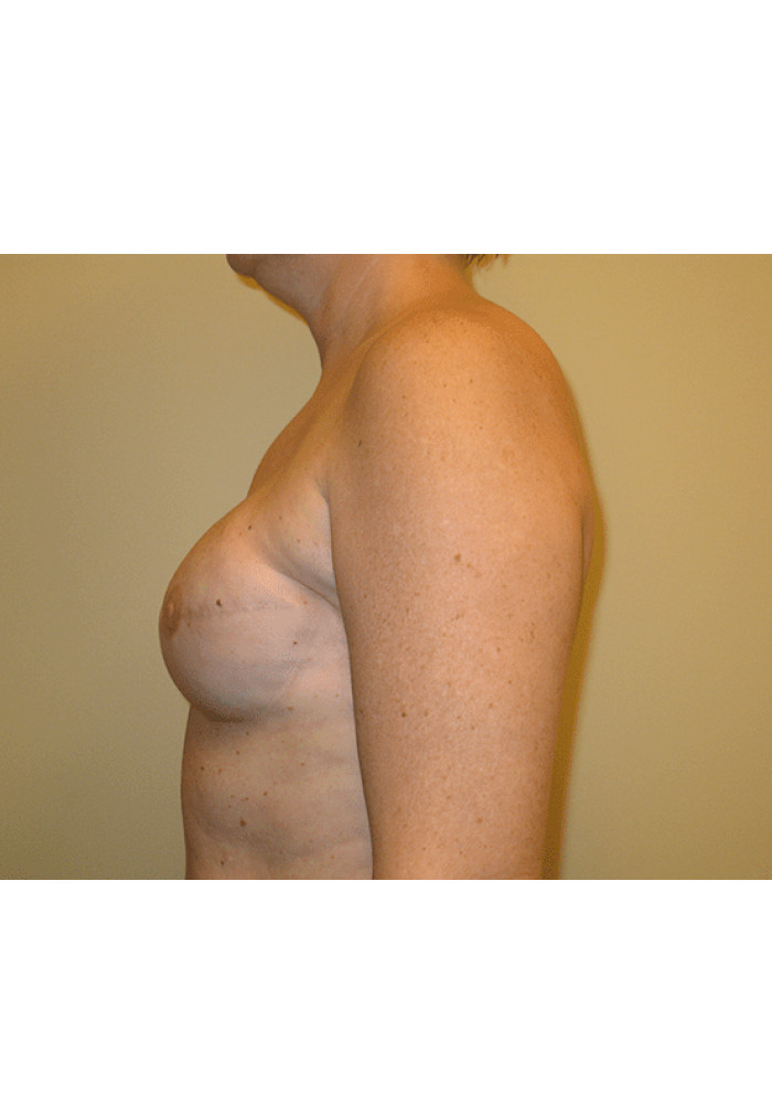 Breast Reconstruction – Case 3
