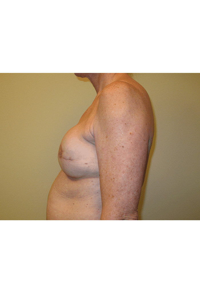 Breast Reconstruction – Case 4