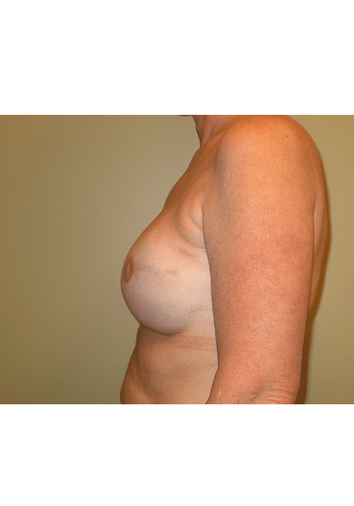 Breast Reconstruction – Case 5