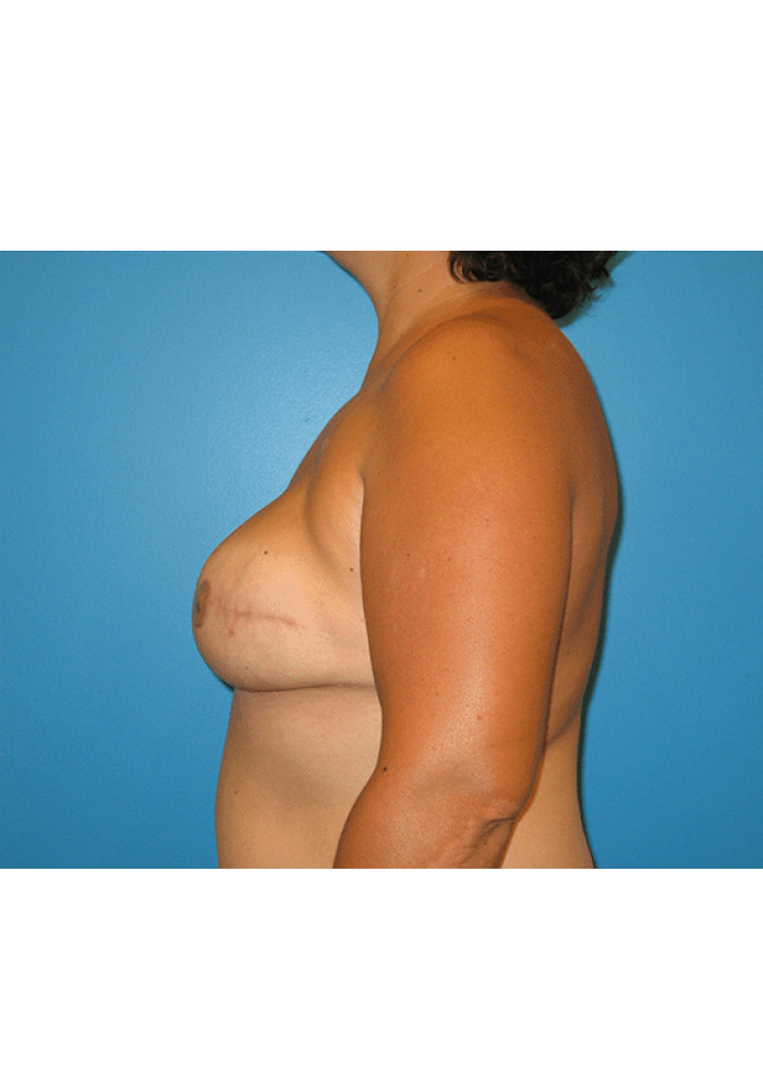 Breast Reconstruction – Case 6
