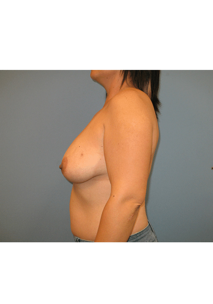 Breast Reconstruction – Case 6