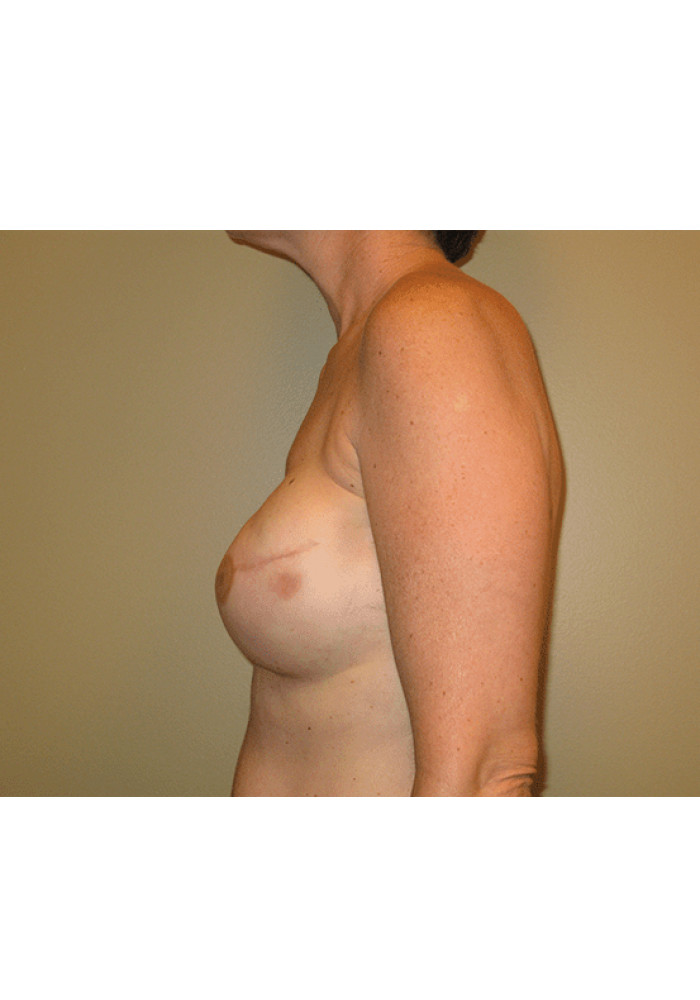 Breast Reconstruction – Case 7