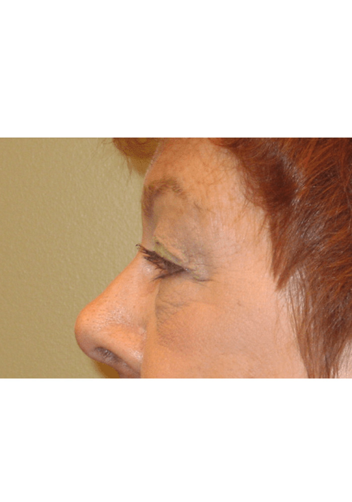 Eyelid Surgery – Case 2