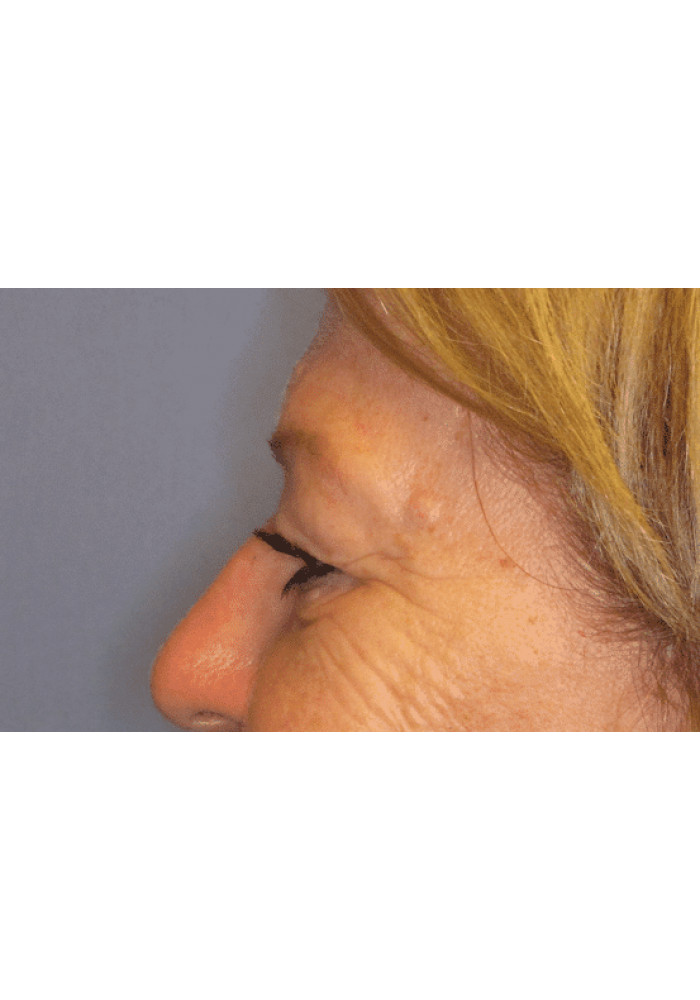 Eyelid Surgery – Case 4