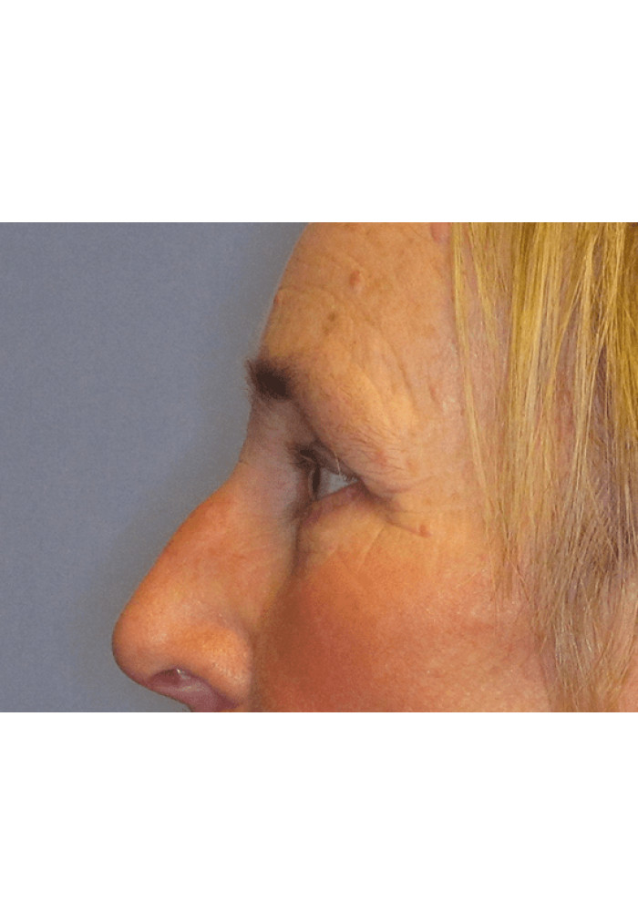 Eyelid Surgery – Case 5