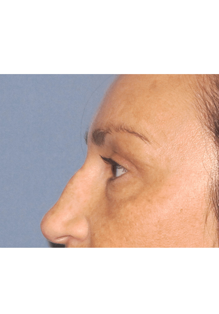 Eyelid Surgery – Case 7
