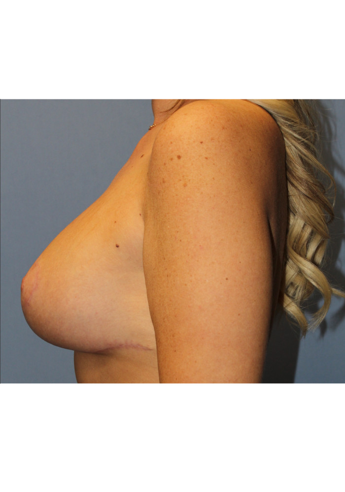 Breast Lift- Case 9