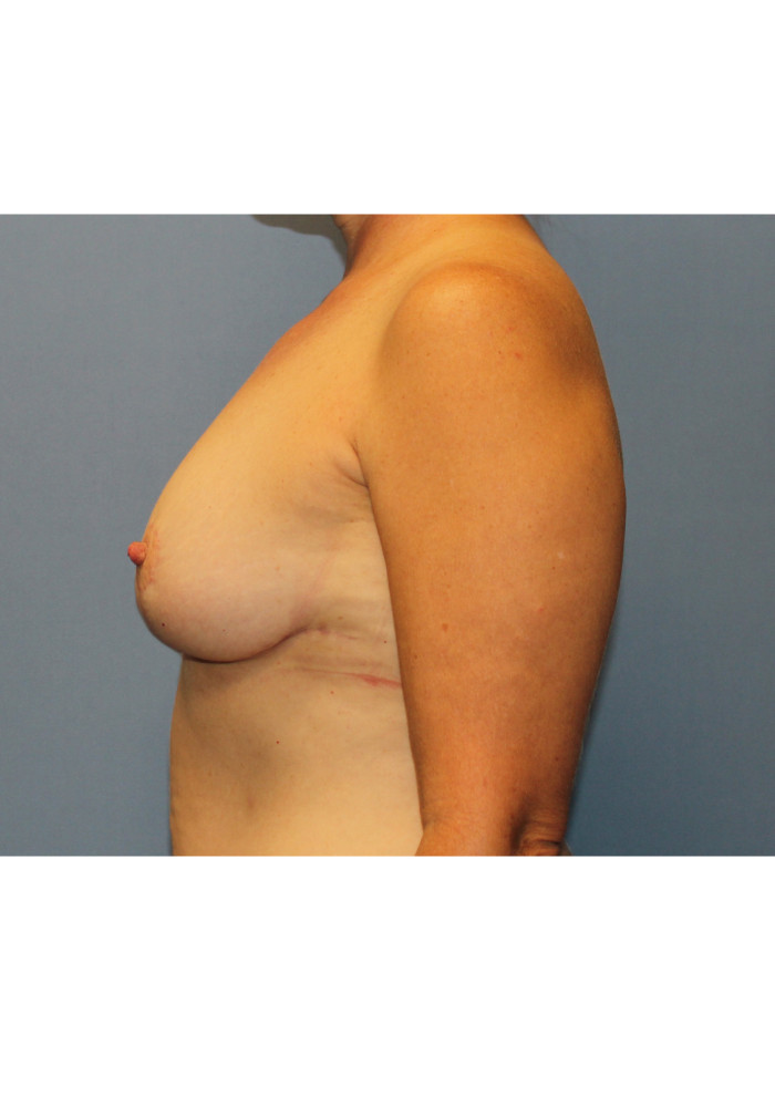 Breast Reduction- Case 4