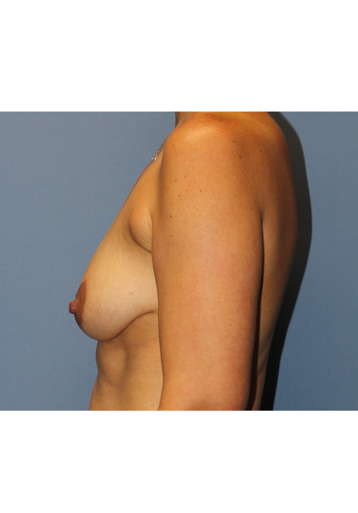 Breast Lift- Case 10